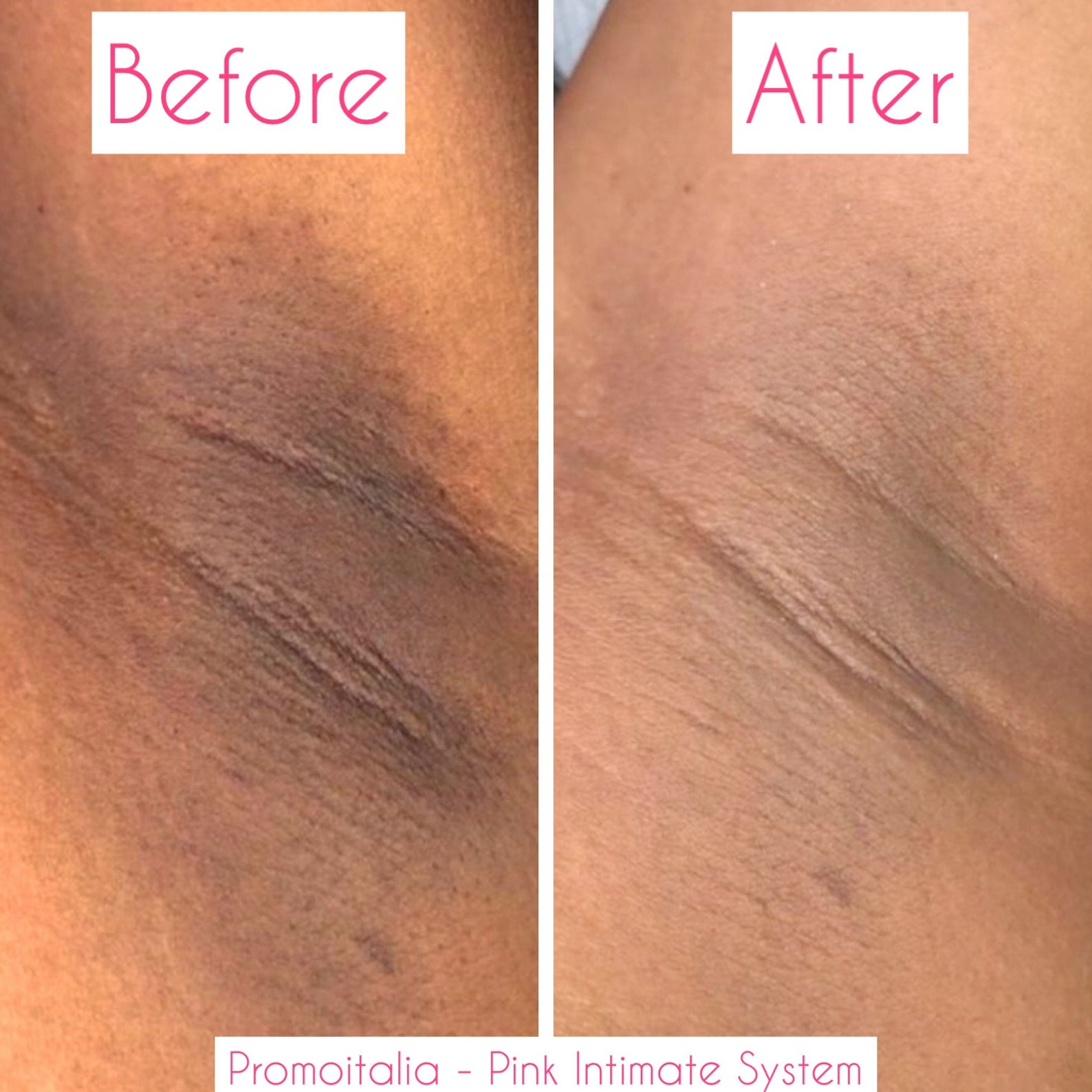 Pink Intimate System Results PromoItalia Pink Intimate System All Natural Skin Bleaching | Etsy