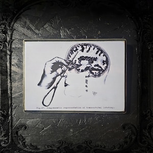 vintage lobotomy poster wall plaque