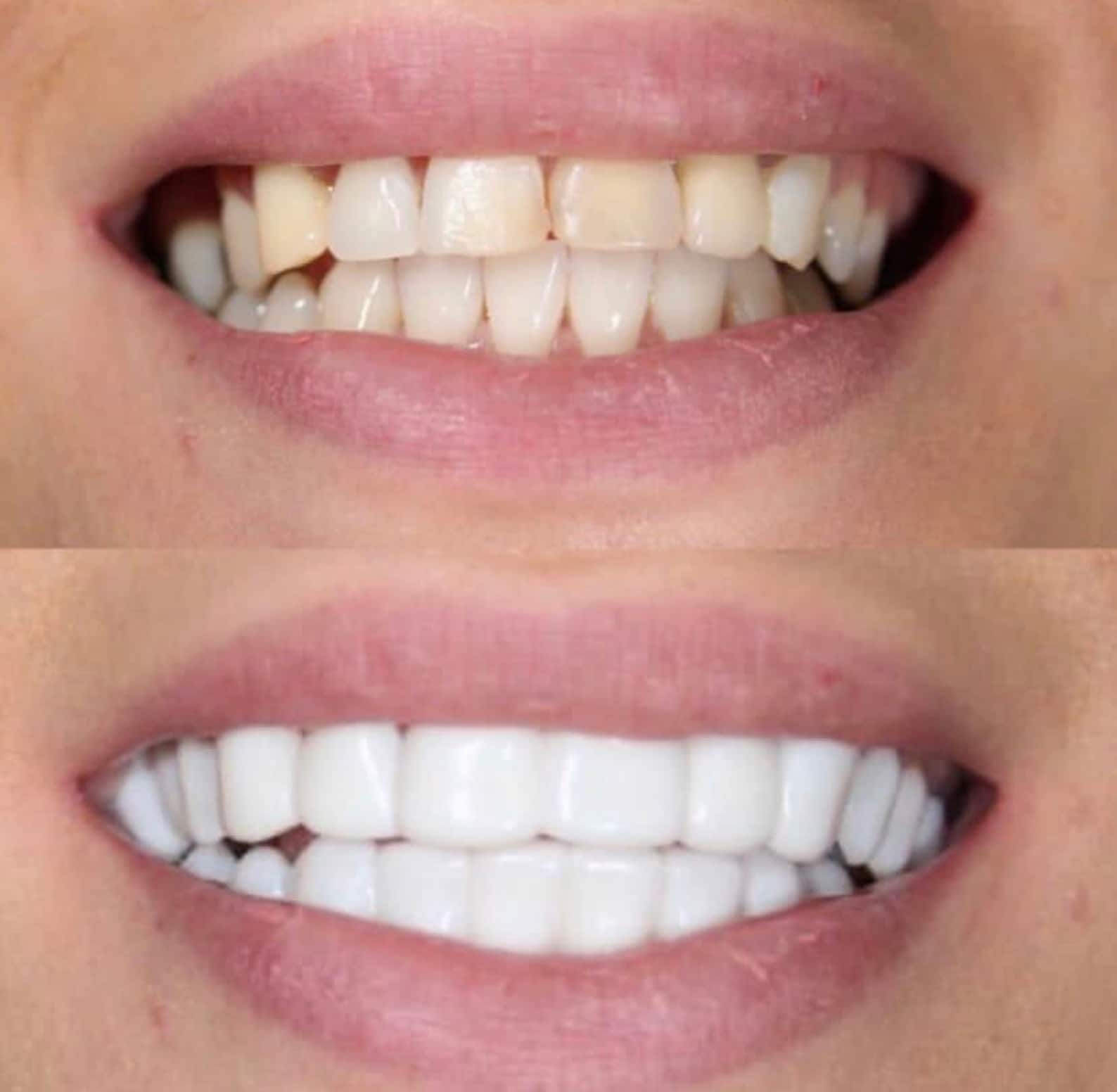 Snap on Veneers Removable Veneers Etsy