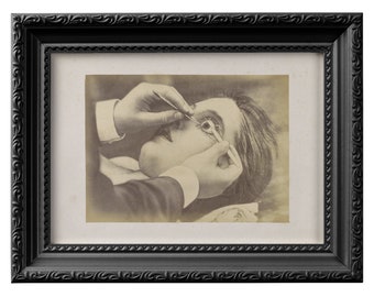 Reproduction photo d'une opération des yeux du XIXe siècle, illustrant l'ablation d'une cataracte. Cadeau original et effrayant pour ophtalmologiste et opticien 0100