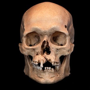 May include: A human skull with a light tan color, set against a black background. The skull has visible eye sockets, nasal cavity, and teeth. The teeth are visible in the open jaw. The skull appears to be a medical or anatomical model.