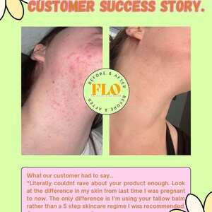 Op de afbeelding: Een voor-en-na-afbeelding die de huidtransformatie van een klant laat zien. De afbeelding bevat twee foto's naast elkaar, met de tekst "CUSTOMER SUCCESS STORY". De "voor"-foto toont huid met onzuiverheden, terwijl de "na"-foto een helderdere huid toont. De tekst bevat ook een klantgetuigenis.
