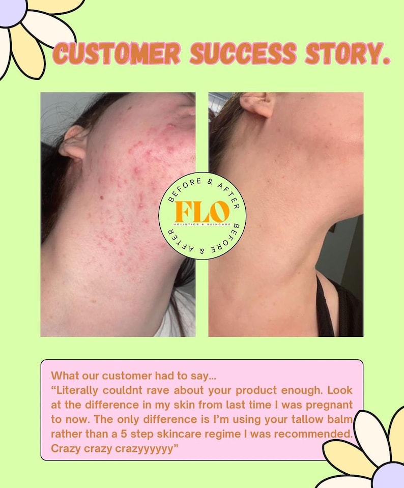 Op de afbeelding: Een voor-en-na-afbeelding die de huidtransformatie van een klant laat zien. De afbeelding bevat twee foto's naast elkaar, met de tekst "CUSTOMER SUCCESS STORY". De "voor"-foto toont huid met onzuiverheden, terwijl de "na"-foto een helderdere huid toont. De tekst bevat ook een klantgetuigenis.