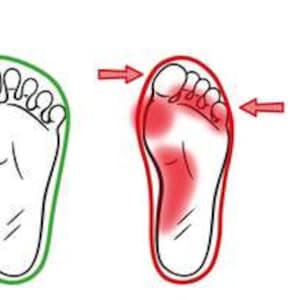 Pu&ograve; includere: Illustrazione di un piede con un contorno rosso che mostra le aree dolorose sul fondo del piede. Il contorno rosso &egrave; sul lato destro dell'immagine, e un piede sano &egrave; mostrato sul lato sinistro dell'immagine.