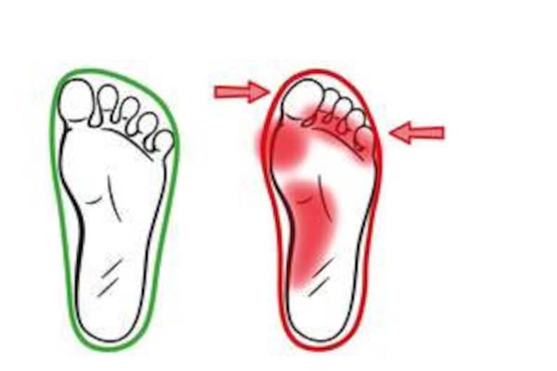 Pu&ograve; includere: Illustrazione di un piede con un contorno rosso che mostra le aree dolorose sul fondo del piede. Il contorno rosso &egrave; sul lato destro dell'immagine, e un piede sano &egrave; mostrato sul lato sinistro dell'immagine.