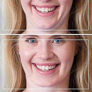 Puede incluir: Dos imágenes lado a lado de una persona sonriendo. La persona tiene cabello rubio, ojos azules y un piercing en la nariz. Los dientes de la persona son visibles en ambas imágenes. Las imágenes están enmarcadas con rectángulos blancos.