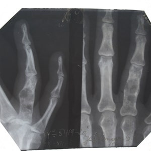 Könnte beinhalten: Schwarzweißes Röntgenbild einer Hand. Das Bild zeigt die Knochen der Hand und Finger. Das Röntgenbild ist mit dem Datum "5/4/49" und dem Text "Dr. Sherman G." beschriftet.