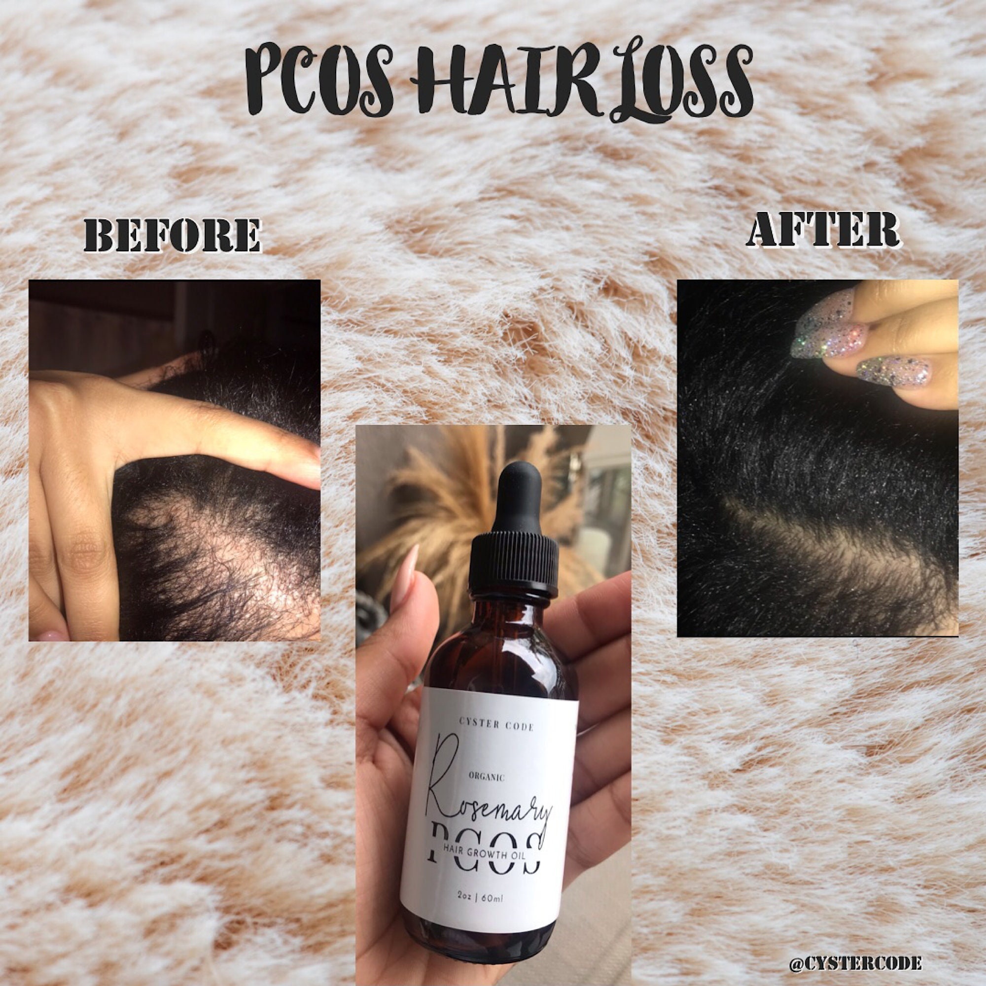 Organic Rosemary PCOS Hair GROWTH Oil for PCOS Hair Loss - Etsy Finland Organic Rosemary PCOS Hair GROWTH Oil for PCOS Hair Loss - Etsy Finland