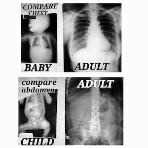 May include: A comparison of chest and abdomen x-rays of a baby, child, and adult. The images show the differences in the size and shape of the lungs and abdomen in people of different ages.
