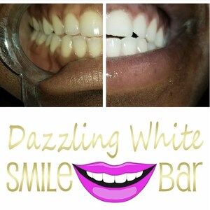 May include: A split image shows teeth before and after whitening. The top half displays the teeth, while the bottom half features the text "Dazzling White SMILE Bar" with a pink smiling mouth graphic.