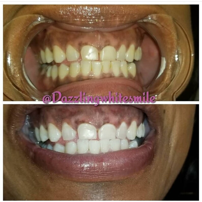 May include: Two images demonstrating teeth whitening results. The top image shows teeth with a yellowish tint, and the bottom image reveals noticeably whiter teeth. The text "@Dazzlingwhitesmile" is present in the image.