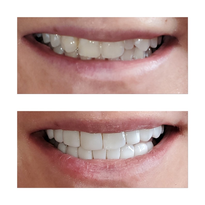 Composite Veneers Step by Step Ebook, Steps to Composite Veneers