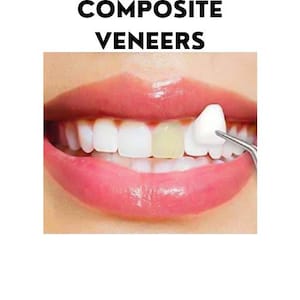 May include: Close-up of a person's teeth with a composite veneer being applied to a yellowed tooth. The veneer is white and is being held in place with a dental tool. The person's lips are pink and slightly parted. The text "Steps of Composite Veneers" is above the image and "Dazzling White Smile" is below the image.