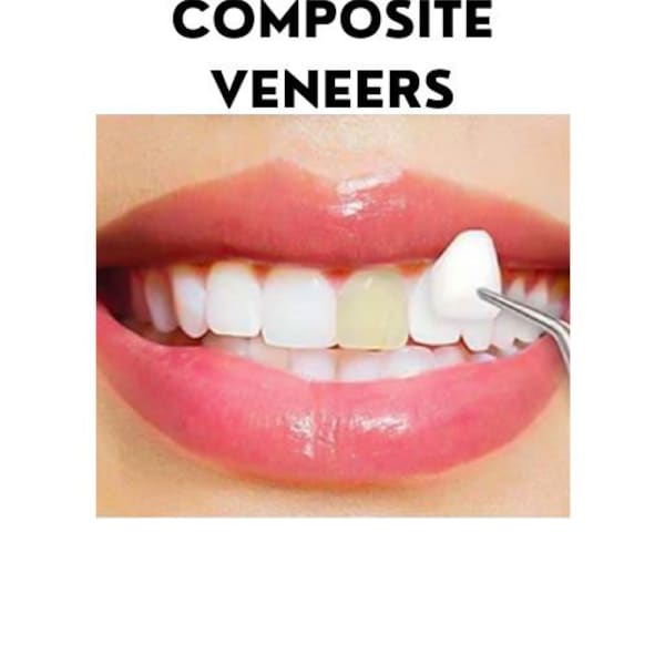 Veneer - Etsy