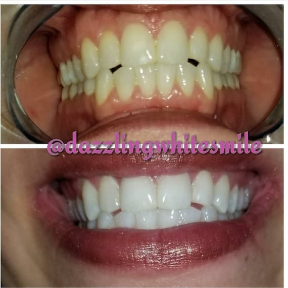 35% HP Teeth Whitening Pen,  Bulk Teeth Whitening Pen,Teeth Whitening Gel, Wholesale Teeth Whitening, Teeth Whitening Pens Hydrogen Peroxide