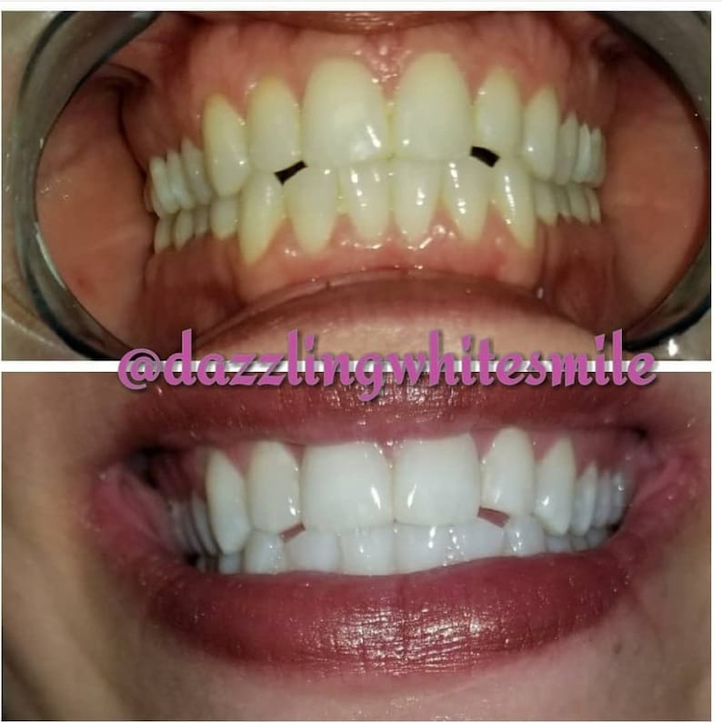 May include: Two images demonstrating teeth whitening results. The top image shows teeth with a yellowish tinge, while the bottom image displays a bright, white smile. The text "@dazzlingwhitesmile" is visible.