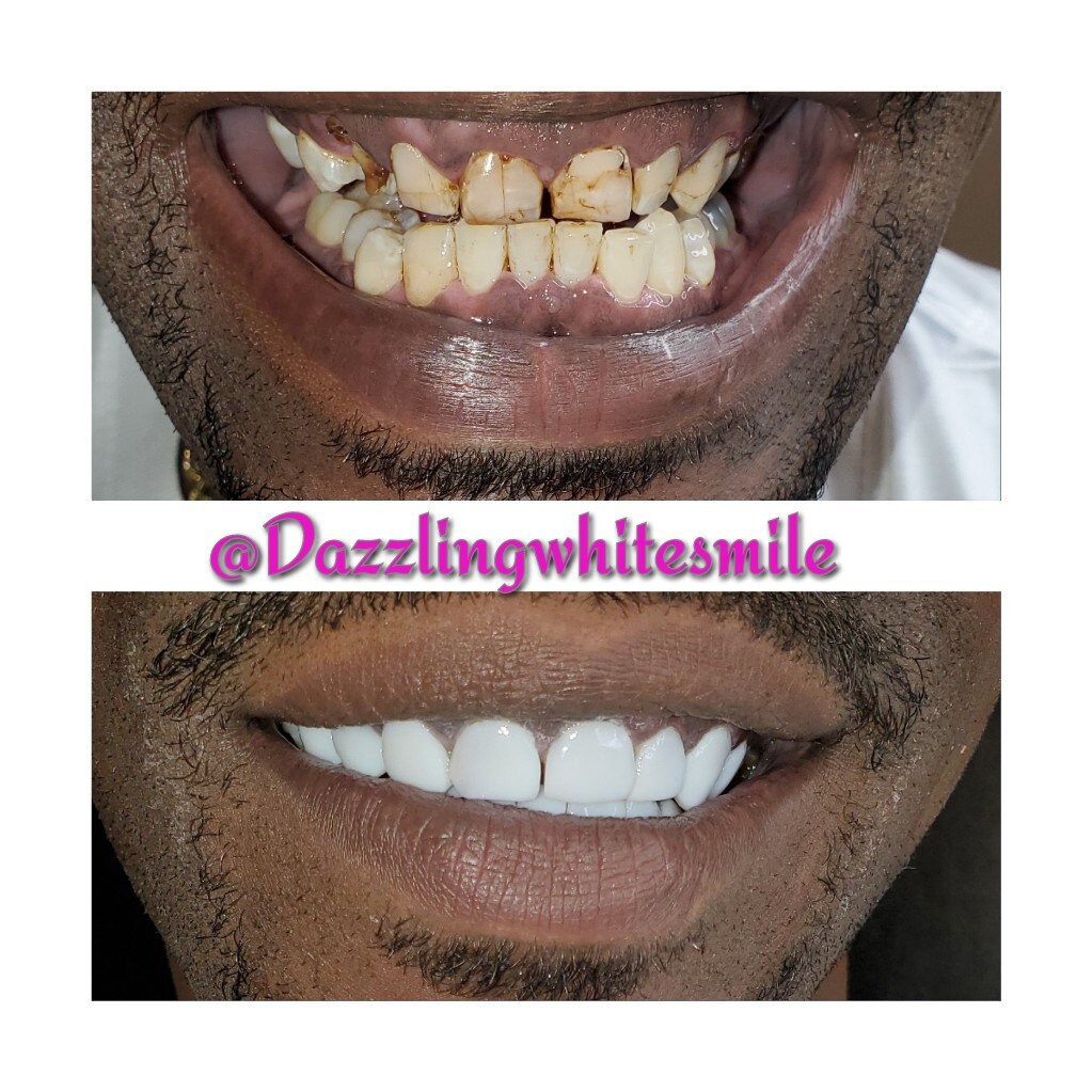 Composite Veneers Step by Step E-book, Steps to Composite Veneers