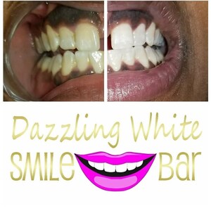 May include: A before-and-after comparison of teeth whitening is shown. The left side displays yellowed teeth, while the right side shows significantly whiter teeth. The image includes the text "Dazzling White SMILE Bar" with a pink lip graphic.