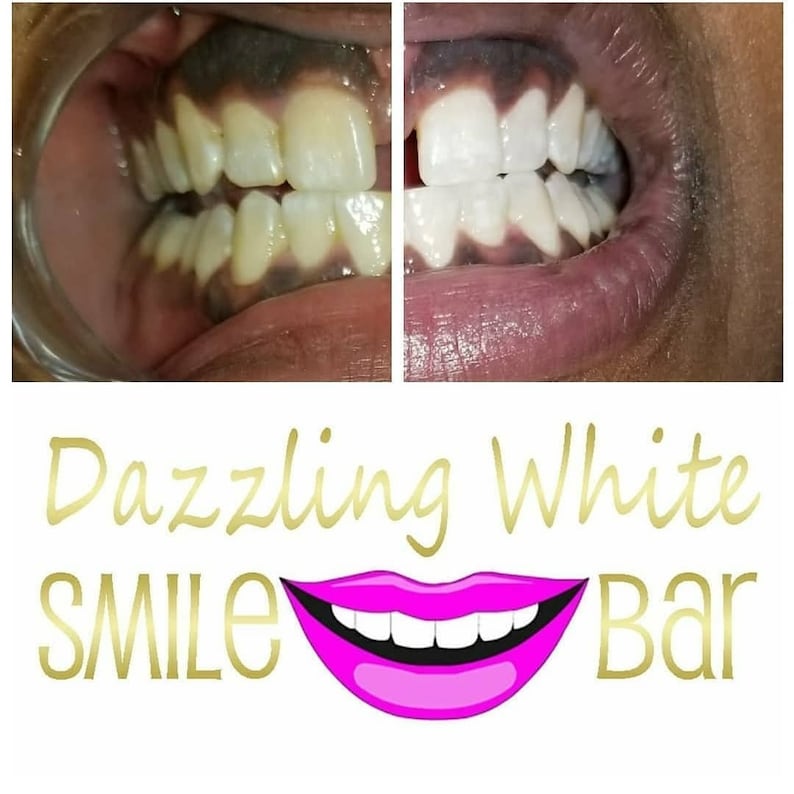 May include: A before-and-after comparison of teeth whitening is shown. The left side displays yellowed teeth, while the right side shows significantly whiter teeth. The image includes the text "Dazzling White SMILE Bar" with a pink lip graphic.