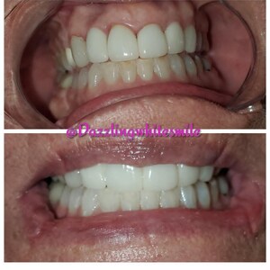 May include: Two images of teeth, one upper and one lower, showcasing bright white dental work. The teeth are uniformly spaced and appear professionally treated. The images are well-lit, highlighting the details of the dental work and the overall appearance.