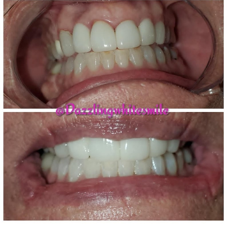 May include: Two images of teeth, one upper and one lower, showcasing bright white dental work. The teeth are uniformly spaced and appear professionally treated. The images are well-lit, highlighting the details of the dental work and the overall appearance.