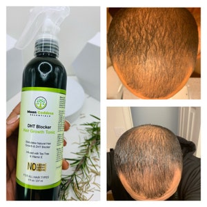 DHT Blocker for female and male pattern baldness