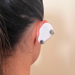 Pendiente de compresión para queloides: tratamiento postoperatorio del lóbulo de la oreja con clip de sujeción fuerte para bultos grandes. imagen 14