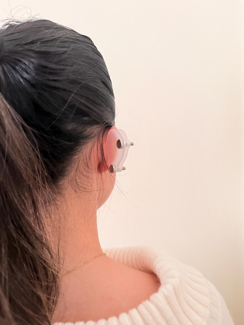 Pendiente de compresión para queloides: tratamiento postoperatorio del lóbulo de la oreja con clip de sujeción fuerte para bultos grandes. imagen 15
