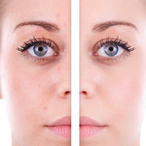 Può includere: Una foto prima e dopo che mostra la differenza nel tono e nella texture della pelle. Il lato sinistro dell'immagine mostra la pelle con imperfezioni e arrossamenti visibili. Il lato destro dell'immagine mostra una pelle chiara e liscia.