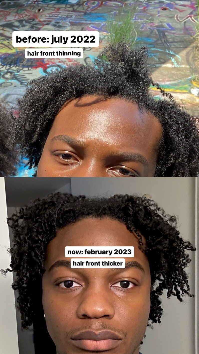 Rosemary, Aloe, Moringa Botanical Hair Oil Hair Growth Hair Regrowth