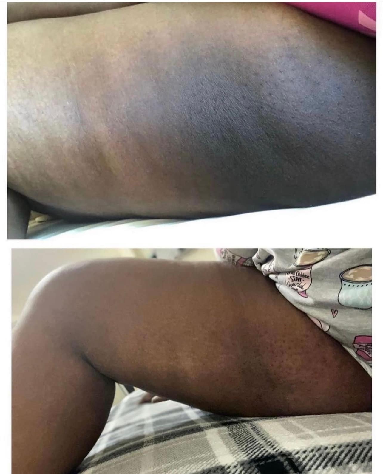 Dark inner 2024 thighs cream