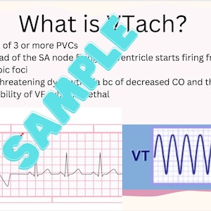 Ventricular Tachycardia Crash Course