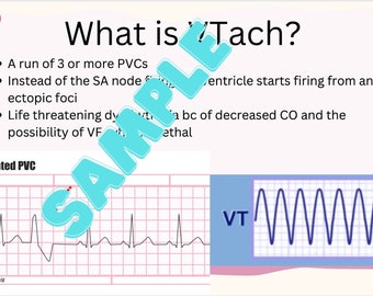 Ventricular Tachycardia Crash Course
