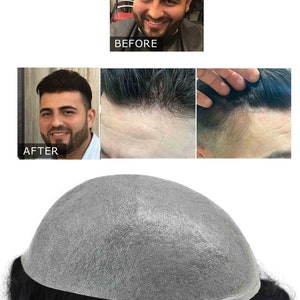 May include: Image showing a comparison of hair loss solutions. The top image shows a man before hair restoration, labeled "BEFORE". The bottom image shows the man after, labeled "AFTER". A hairpiece is also shown.