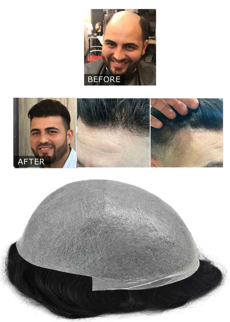 May include: Image showing a comparison of hair loss solutions. The top image shows a man before hair restoration, labeled "BEFORE". The bottom image shows the man after, labeled "AFTER". A hairpiece is also shown.