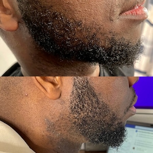 Patchy Beard Growth Oil: Thicken & Fill in Uneven Areas Naturally