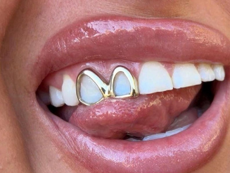 Puede incluir: Primer plano de la boca de una persona con una rejilla de oro. La rejilla tiene forma de coraz&oacute;n de doble cara y cubre los dientes delanteros.