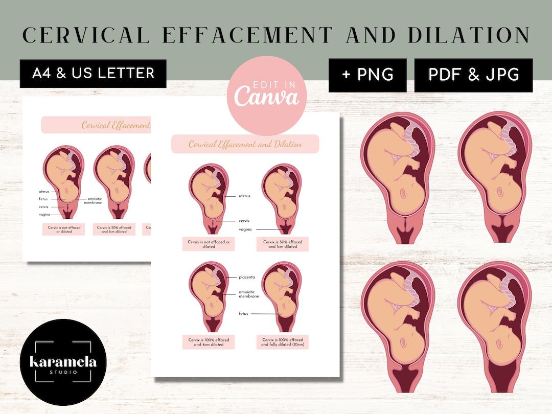 Cervical Effacement and Dilation PNG Images & Canva PDF JPG Female Reproductive System