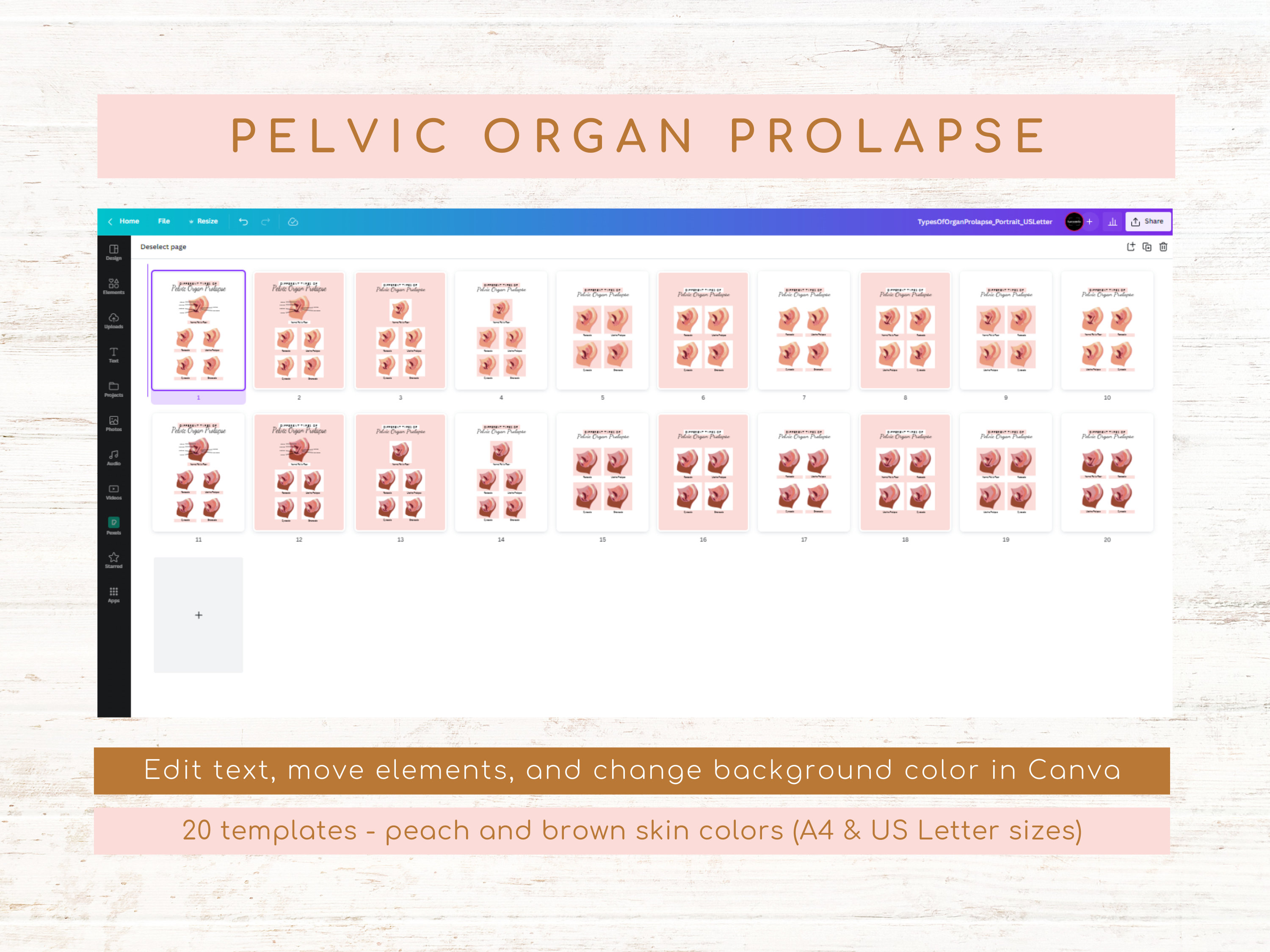 Icd 10 Code For Stage Iv Pelvic Organ Prolapse