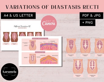 Diastasis Recti Variations Diagram | Abdominal Muscles Separation | Linea Alba | PDF + JPG | PNG & Canva Templates | Digital download