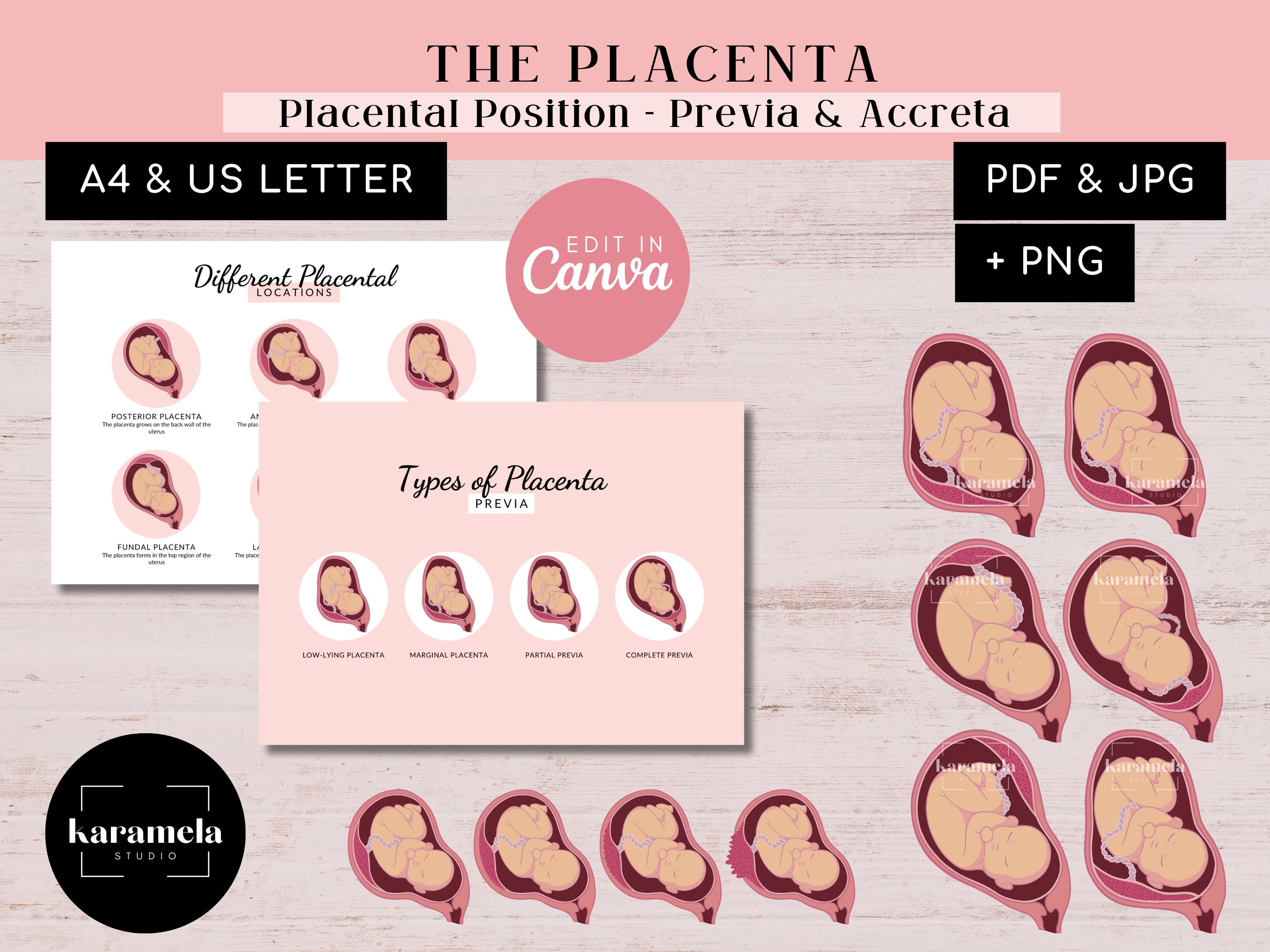 Different Placental Positions Types of Placenta Previa Placenta Accreta