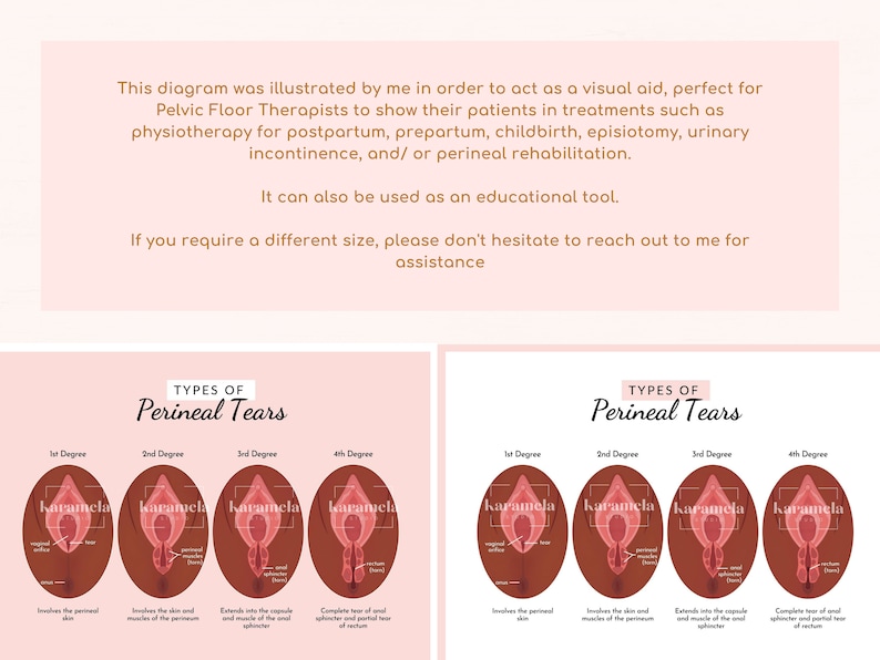 Perineal Tears PNG Images & Canva Templates PDF + JPG Episiotomy Obstetric Laceration