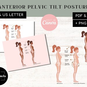 Vordere Beckenneigung und neutrale Haltung | PDF + JPG | PNG- und Canva-Vorlagen | Vorwärts geneigtes Becken | Digitaler Download