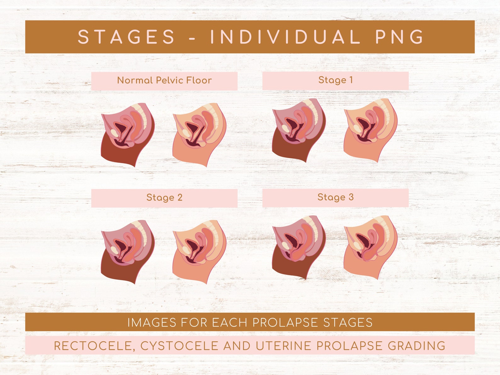 Types Of Pelvic Organ Prolapse Rectocele Stages Cystocele Stages types-of-pelvic-organ-prolapse-rectocele-stages-cystocele-stages