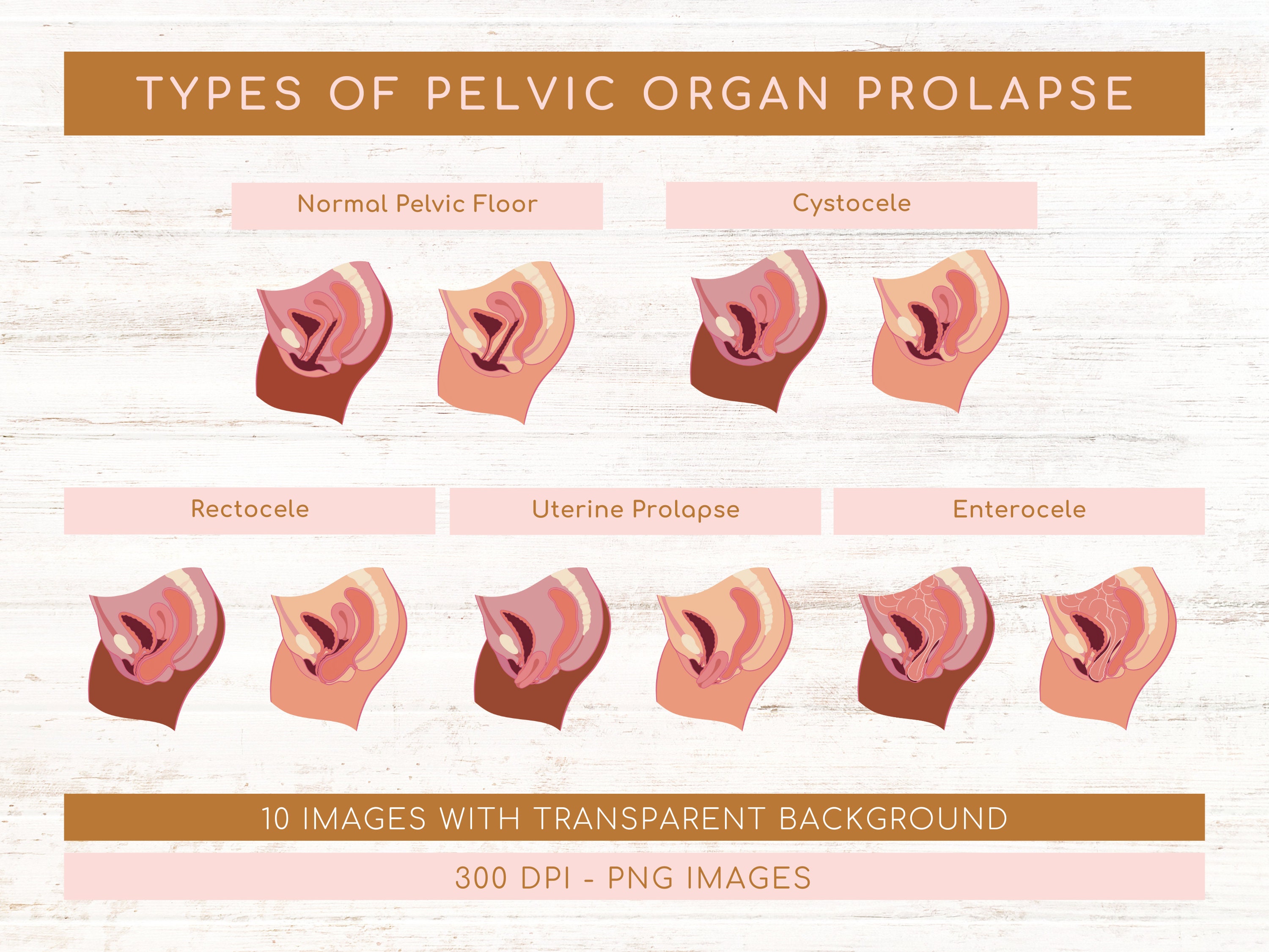 Types Of Pelvic Organ Prolapse Rectocele Stages Cystocele Stages