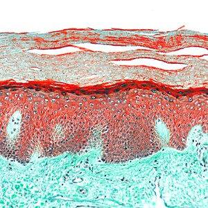 May include: Microscopic image of human skin tissue showing the epidermis and dermis layers. The epidermis is the outermost layer of skin and is composed of epithelial cells. The dermis is the layer of skin beneath the epidermis and is composed of connective tissue, blood vessels, and nerves.