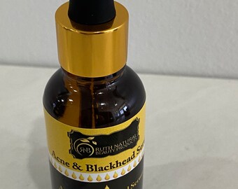 Suero para acné y puntos negros/ Suero natural/ Orgánico