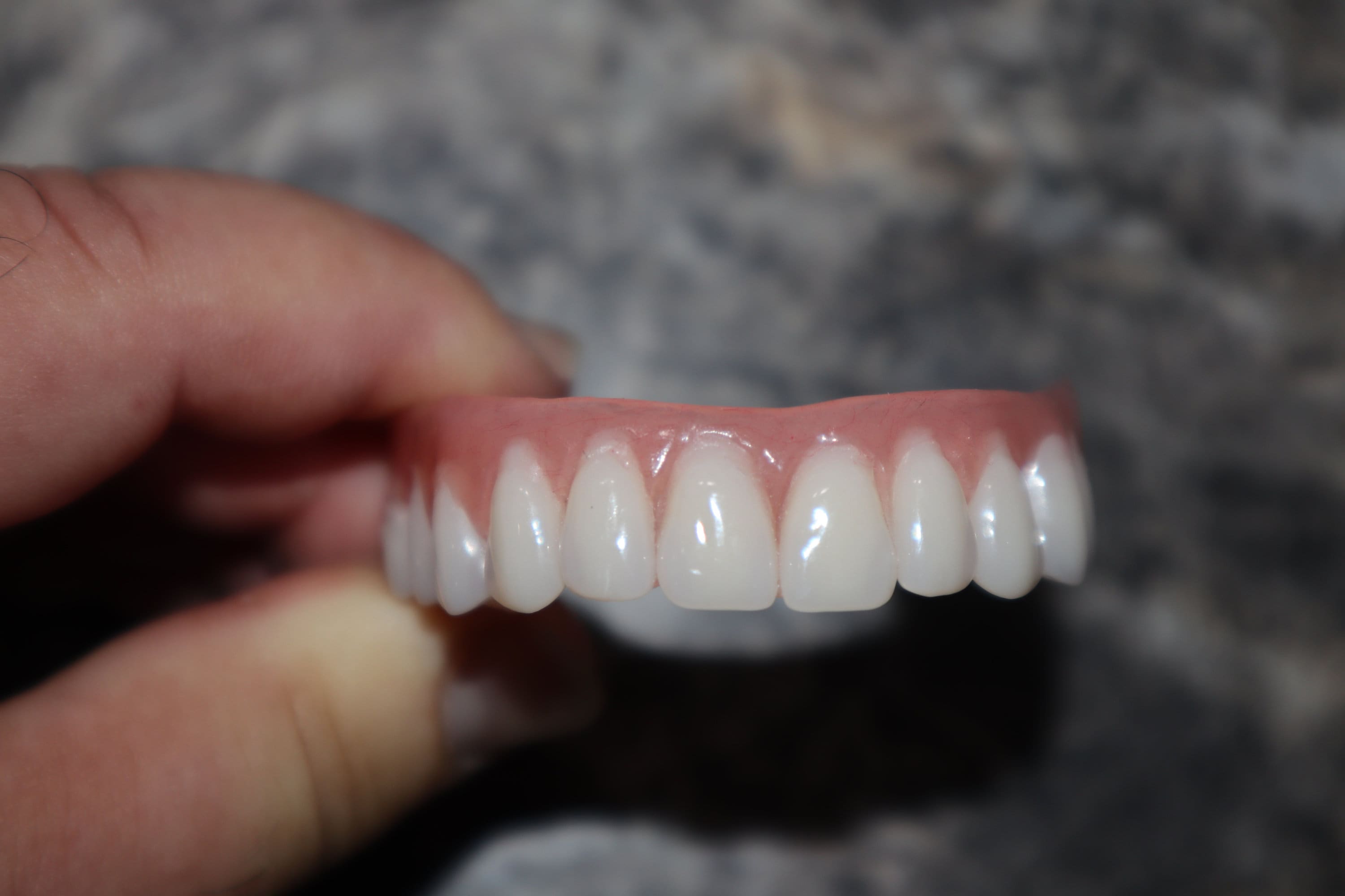 Horseshoe Upper Dentures Without Implantsprivacy - quidxqx
