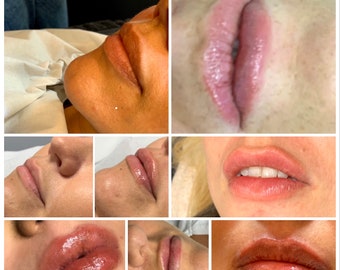 Lip filler training manual