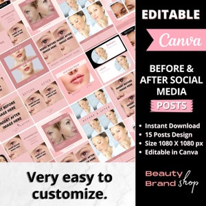 Editable Skincare Before and After Templates, Esthetician Instagram Posts, Cosmetic, Make Up, Med Spa, Beauty Salon, Skincare Canva Template